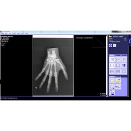 Phantom X-ray Tangan atau Manus