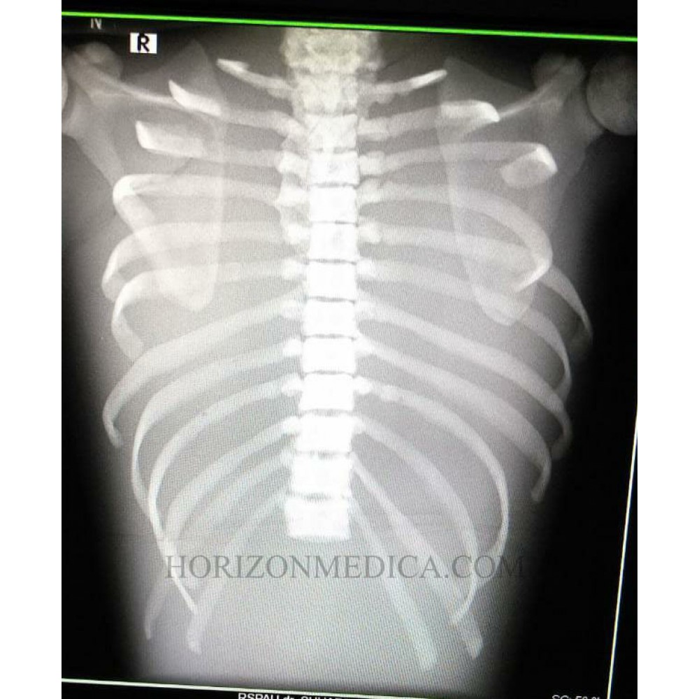 Phantom X-ray Dada atau Thorax