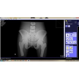 Phantom X-ray Pinggang, BNO atau Pelvis