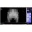 Phantom X-ray Pinggang, BNO atau Pelvis